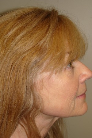 Laser Resurfacing Before and After 01 | Grover Aesthetics