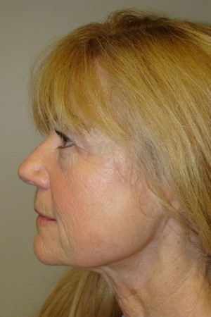 Laser Resurfacing Before and After 01 | Grover Aesthetics