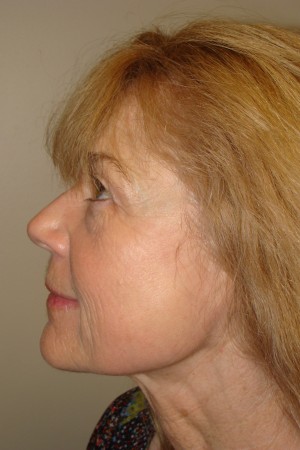 Laser Resurfacing Before and After 01 | Grover Aesthetics