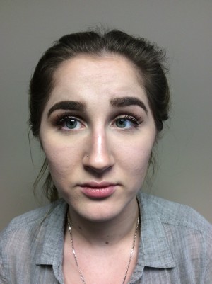 Non Surgical Rhinoplasty Before and After | Grover Aesthetics