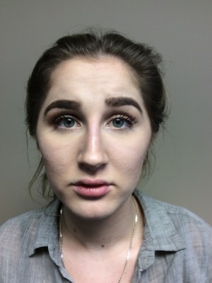 Non Surgical Rhinoplasty Before and After | Grover Aesthetics