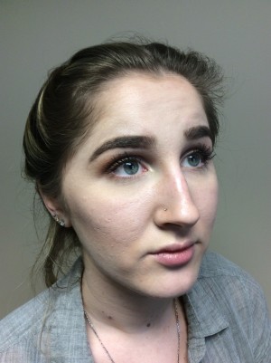 Non Surgical Rhinoplasty Before and After 01 | Grover Aesthetics