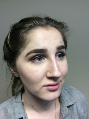 Non Surgical Rhinoplasty Before and After 01 | Grover Aesthetics