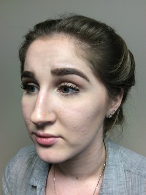 Non Surgical Rhinoplasty Before and After 01 | Grover Aesthetics