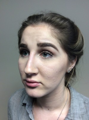 Non Surgical Rhinoplasty Before and After 01 | Grover Aesthetics