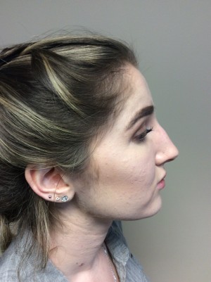 Non Surgical Rhinoplasty Before and After 01 | Grover Aesthetics