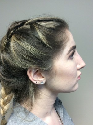 Non Surgical Rhinoplasty Before and After 01 | Grover Aesthetics