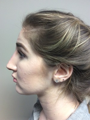 Non Surgical Rhinoplasty Before and After 01 | Grover Aesthetics