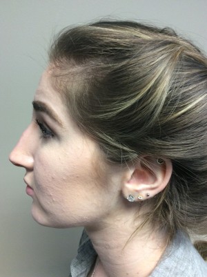 Non Surgical Rhinoplasty Before and After 01 | Grover Aesthetics