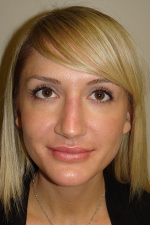 Non Surgical Rhinoplasty Before and After | Grover Aesthetics