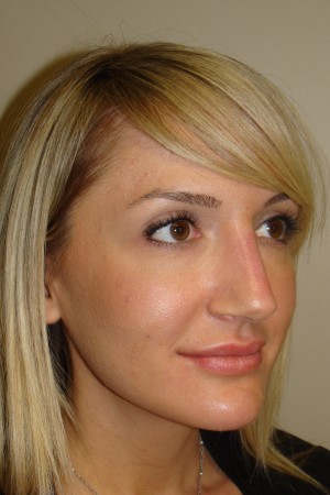 Non Surgical Rhinoplasty Before and After 02 | Grover Aesthetics
