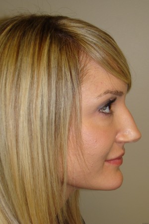 Non Surgical Rhinoplasty Before and After 02 | Grover Aesthetics