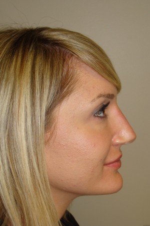 Non Surgical Rhinoplasty Before and After 02 | Sanjay Grover MD FACS