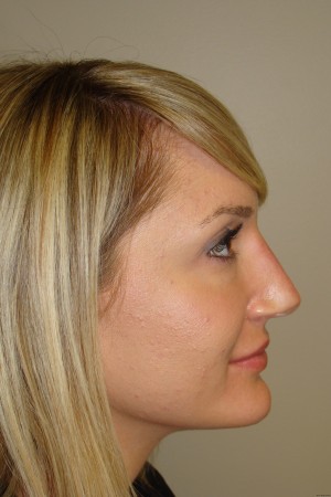 Non Surgical Rhinoplasty Before and After 02 | Grover Aesthetics