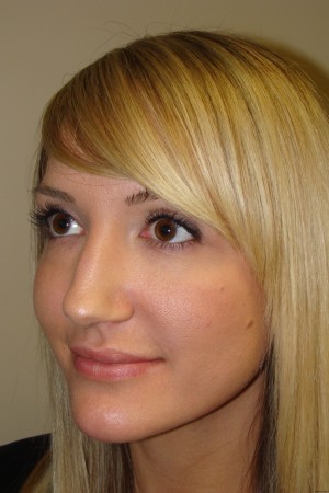 Non Surgical Rhinoplasty Before and After 02 | Grover Aesthetics