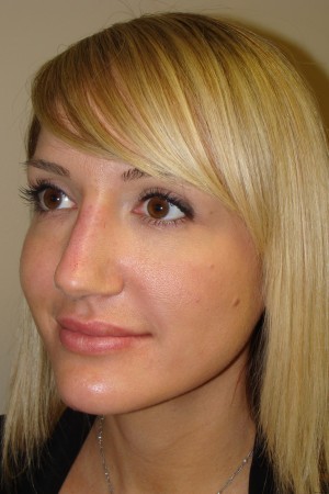 Non Surgical Rhinoplasty Before and After 02 | Grover Aesthetics