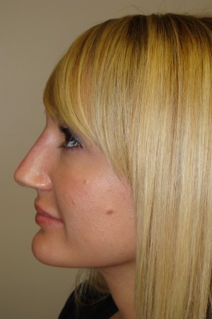 Non Surgical Rhinoplasty Before and After 02 | Grover Aesthetics