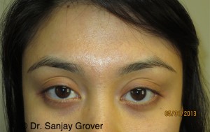 Restylane Before and After 01 | Sanjay Grover MD FACS