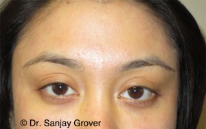 Restylane Before and After 01 | Sanjay Grover MD FACS
