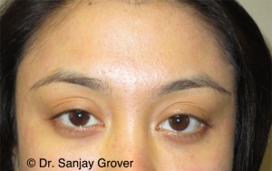 Restylane Before and After | Sanjay Grover MD FACS