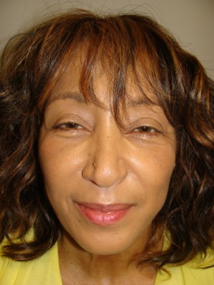 Sculptra Before and After | Grover Aesthetics