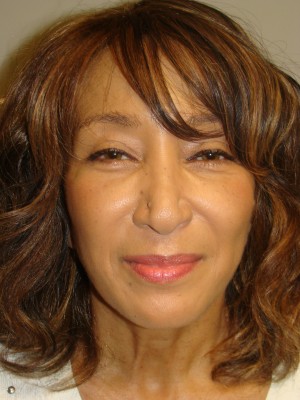 Sculptra Before and After | Grover Aesthetics