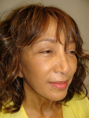 Sculptra Before and After 01 | Grover Aesthetics