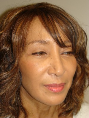 Sculptra Before and After 01 | Grover Aesthetics