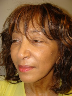 Sculptra Before and After 01 | Grover Aesthetics