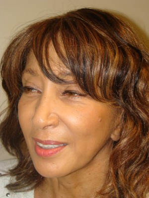 Sculptra Before and After 01 | Grover Aesthetics