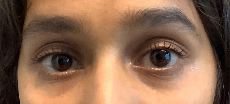 Tear Trough Before and After 01 | Grover Aesthetics