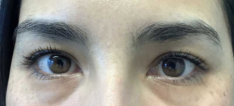 Tear Trough Before and After 01 | Grover Aesthetics