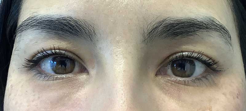 Tear Trough Before and After 02 | Grover Aesthetics