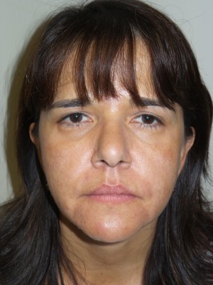 Ultherapy Before and After | Grover Aesthetics