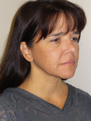 Ultherapy Before and After 01 | Grover Aesthetics