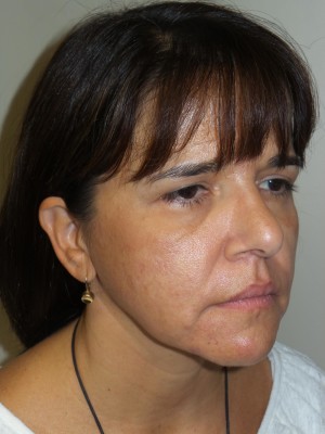 Ultherapy Before and After 01 | Grover Aesthetics