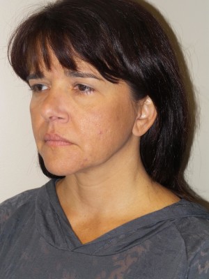 Ultherapy Before and After 01 | Grover Aesthetics