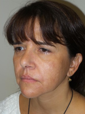 Ultherapy Before and After 01 | Grover Aesthetics