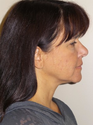 Ultherapy Before and After 01 | Grover Aesthetics