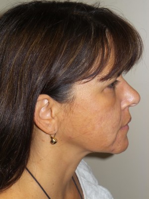 Ultherapy Before and After 01 | Grover Aesthetics