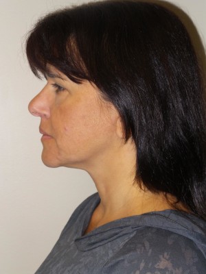 Ultherapy Before and After 01 | Grover Aesthetics