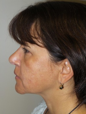 Ultherapy Before and After 01 | Grover Aesthetics