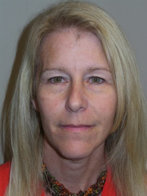 Ultherapy Before and After | Grover Aesthetics