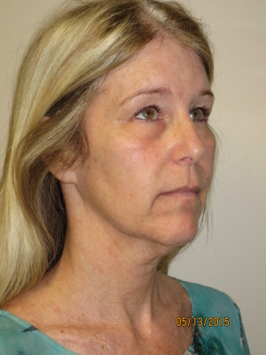 Ultherapy Before and After 02 | Grover Aesthetics