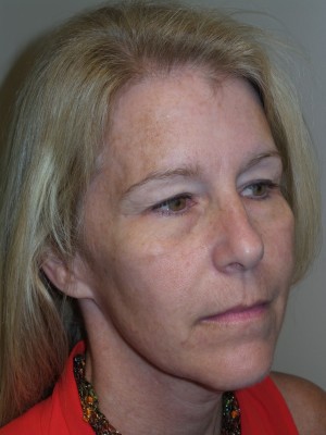 Ultherapy Before and After 02 | Grover Aesthetics