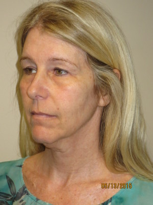 Ultherapy Before and After 02 | Grover Aesthetics