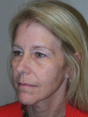 Ultherapy Before and After 02 | Grover Aesthetics
