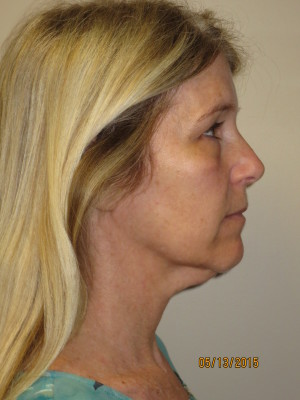 Ultherapy Before and After 02 | Grover Aesthetics