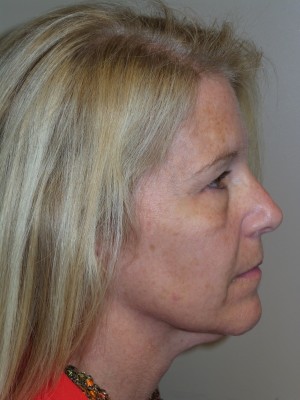 Ultherapy Before and After 02 | Grover Aesthetics