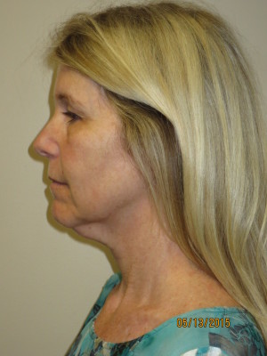 Ultherapy Before and After 02 | Grover Aesthetics